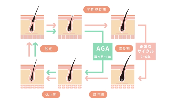 毛周期とAGAとの関係について